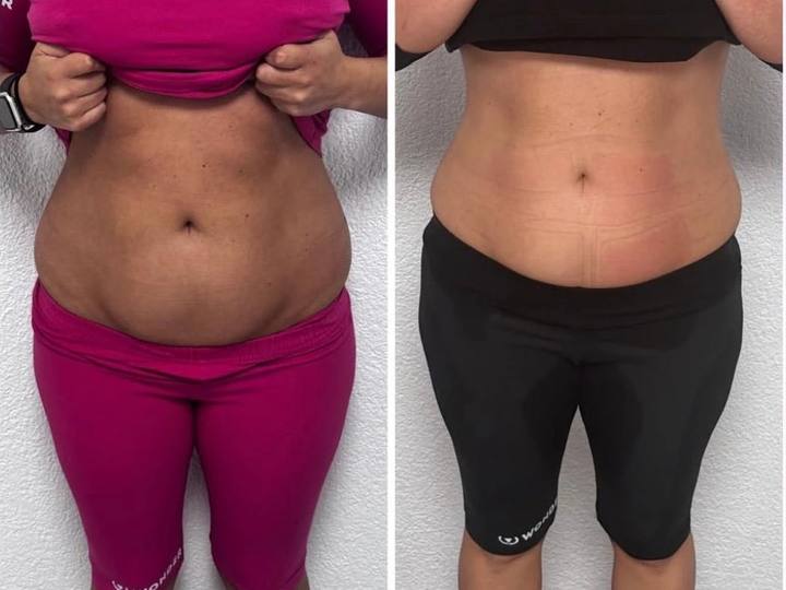 Before / After: Flatter, firmer abdomen