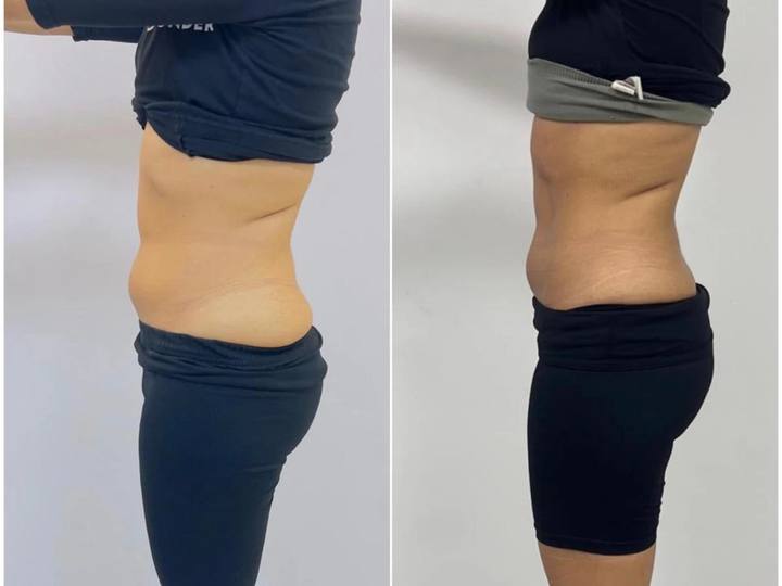 Before / After: A slimmer waistline