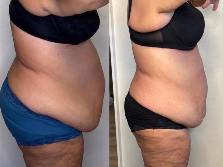 Before / After: Less volume at the abdomen and sides